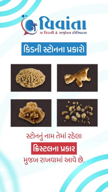 Did you know not all kidney stones are the same? 🤔💎
Understanding the type of stone you have is the first step toward the right treatment and preventing them from coming back! At Vivanta The Kidney & Surgical Hospital, we identify the root cause to give you lasting relief.
Common Types of Kidney Stones:
Calcium-Oxalate: The most common type, often caused by low water intake and high-oxalate foods.
Uric Acid: Frequently linked to high-protein or non-veg diets.
Struvite: Usually caused by urinary tract infections and can grow quite large.
Cystine: A rarer, hereditary type of stone.
👨⚕️ Dr. Sagar Katudiya
MB, MS, DNB Urology | Vivanta The Kidney & Surgical Hospital
📲 +91 94272 65827 | +91 99046 99029
📍 404-406, 4th Floor, Aditya Complex-B, VIP Circle, Utran, Surat
#KidneyStones, #UrologyHealth, #VivantaHospital, #KidneyCare, #DrSagarKatudiya, #HealthEducation, #UroSurgeon, #KidneyStoneTypes, #SuratHealthcare, #MedicalAwareness, #UrologySurat, #HealthyLiving, #KidneyDiseasePrevention, #SuratDoctors, #GujaratHealth, #LaparoscopicSurgery, #UrologyExpert, #VivantaKidneyHospital, #HealthcareTips, #SuratCity
( Types of kidney stones, calcium oxalate stones, uric acid stones symptoms, best urologist in Surat, Vivanta Kidney Hospital, kidney stone prevention tips, Dr. Sagar Katudiya urologist, urology hospital Gujarat, struvite stone causes, cystine stone treatment, kidney health awareness, Surat medical advice, kidney stone removal Surat, advanced urology care, kidney stone diet, urosurgeon Gujarat, best kidney doctor Surat, healthcare services Surat, kidney stone expert, Vivanta hospital Surat services )